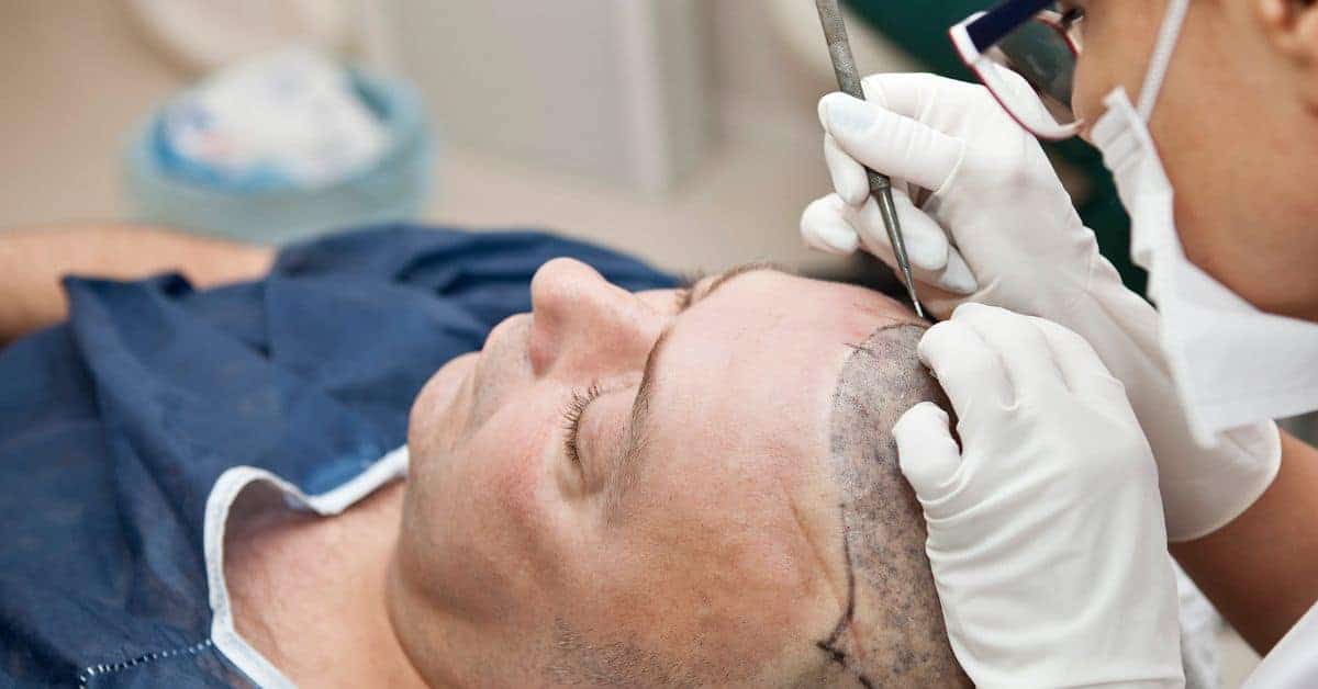 אתם עושים השתלת שיער? קבלו 4 טיפים חשובים להחלמה